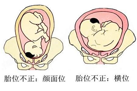 孕夫難產|4種最易導致難產的胎位 如何避免？